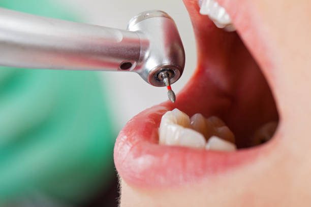 Best Emergency Tooth Extraction in Flowery Branch, GA